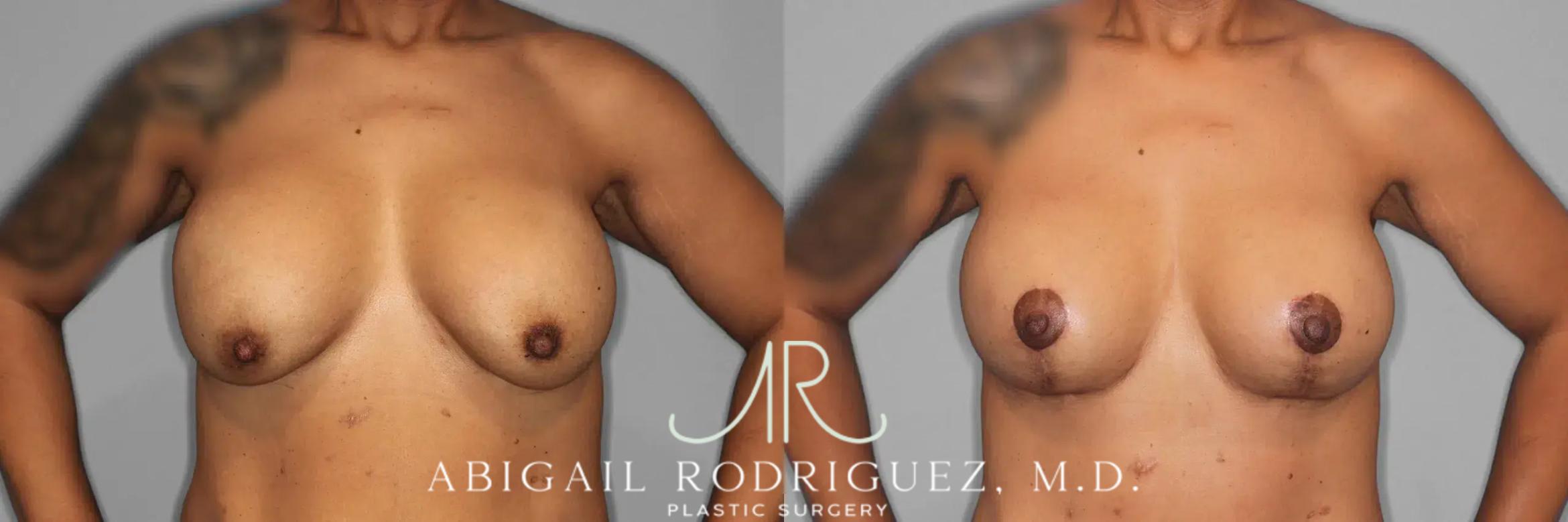 Before & After Breast Lift with Augmentation Case 259561 View 2 View in Houston, TX