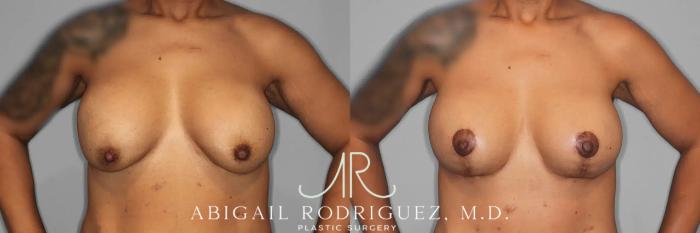 Before & After Breast Lift with Augmentation Case 259561 View 2 View in Houston, TX