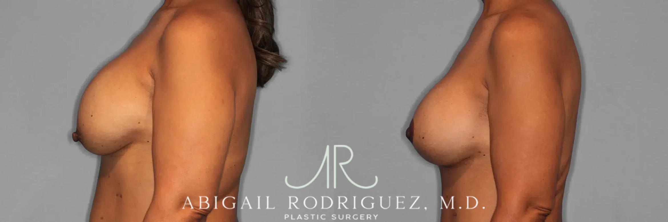 Before & After Breast Lift with Augmentation Case 259561 View 4 View in Houston, TX
