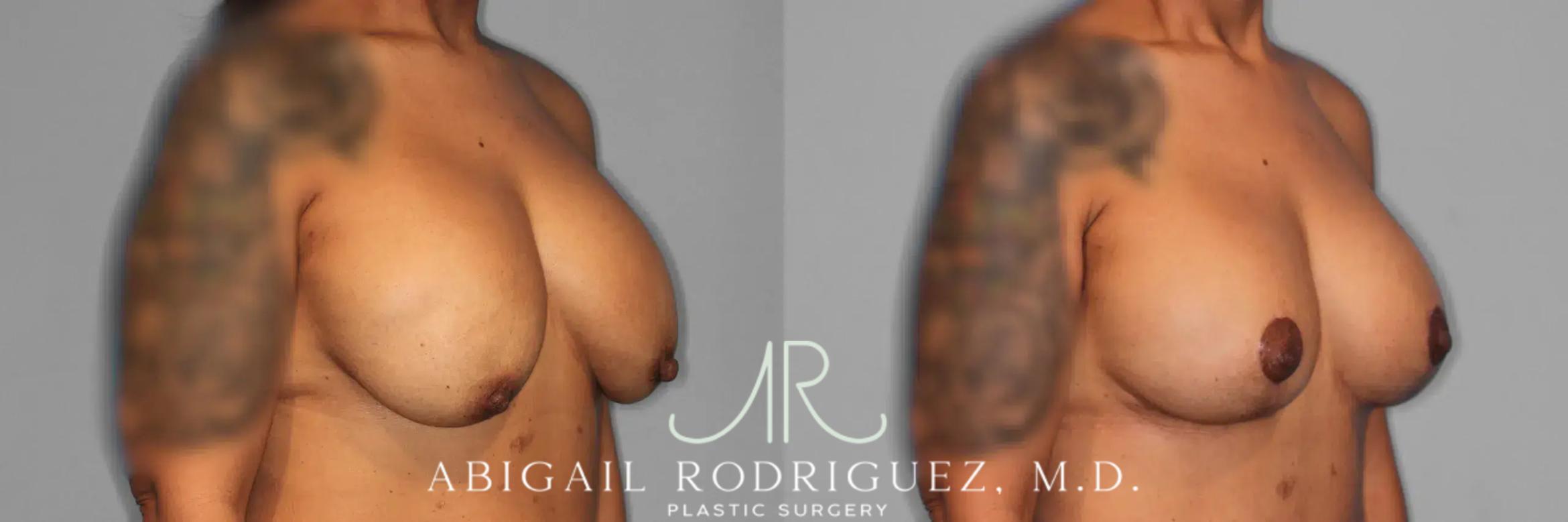 Before & After Breast Lift with Augmentation Case 259561 View 5 View in Houston, TX