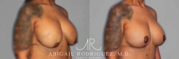 Before & After Breast Lift with Augmentation Case 259561 View 5 View in Houston, TX