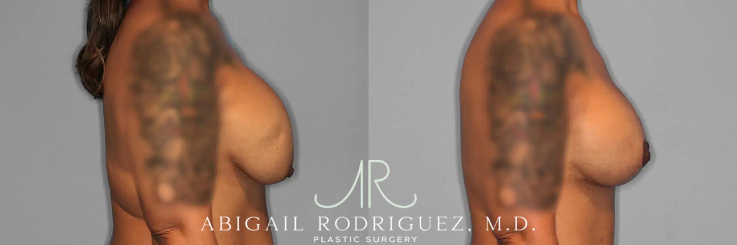 Before & After Breast Lift with Augmentation Case 259561 View 6 View in Houston, TX