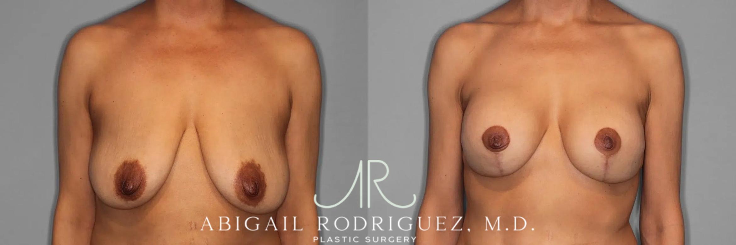 Before & After Breast Lift with Augmentation Case 345995 Front View in Houston, TX