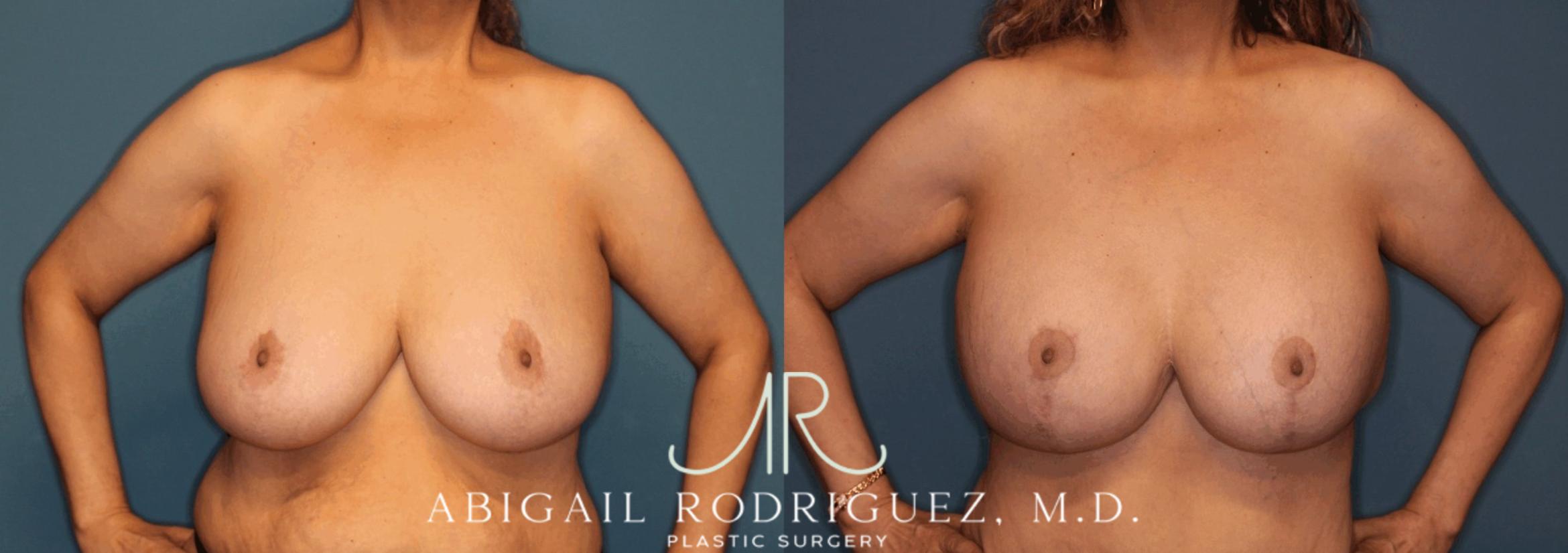 Before & After Breast Lift with Augmentation Case 345997 Front Arms Out View in Houston, TX