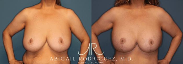 Before & After Breast Lift with Augmentation Case 345997 Front Arms Out View in Houston, TX