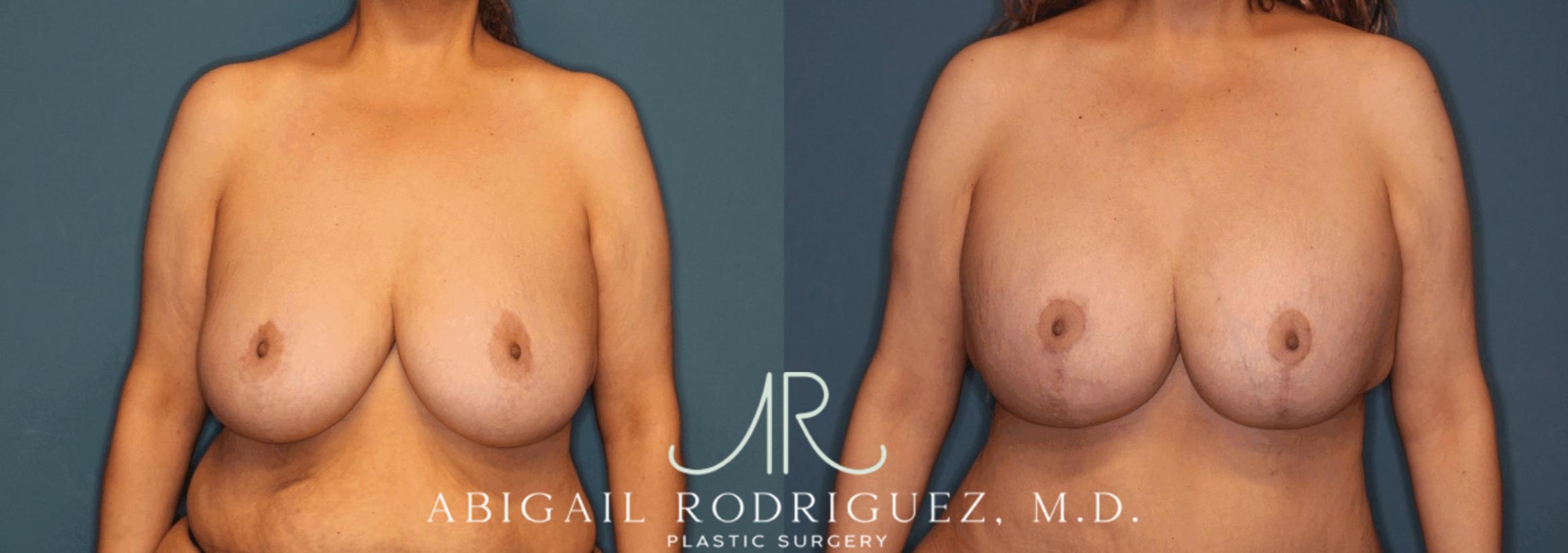 Before & After Breast Lift with Augmentation Case 345997 Front View in Houston, TX