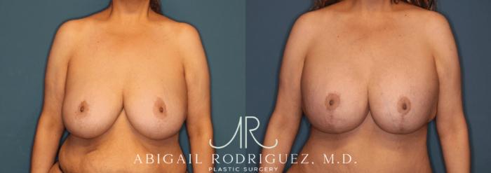 Before & After Breast Lift with Augmentation Case 345997 Front View in Houston, TX