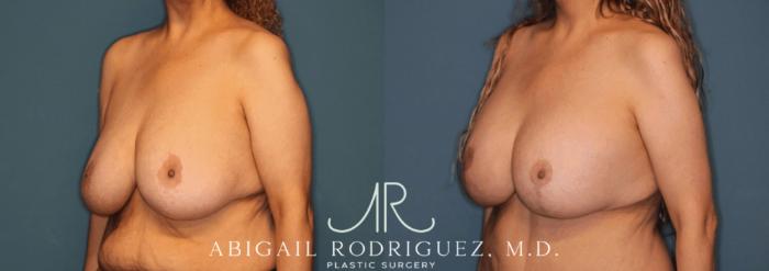 Before & After Breast Lift with Augmentation Case 345997 Left Oblique View in Houston, TX