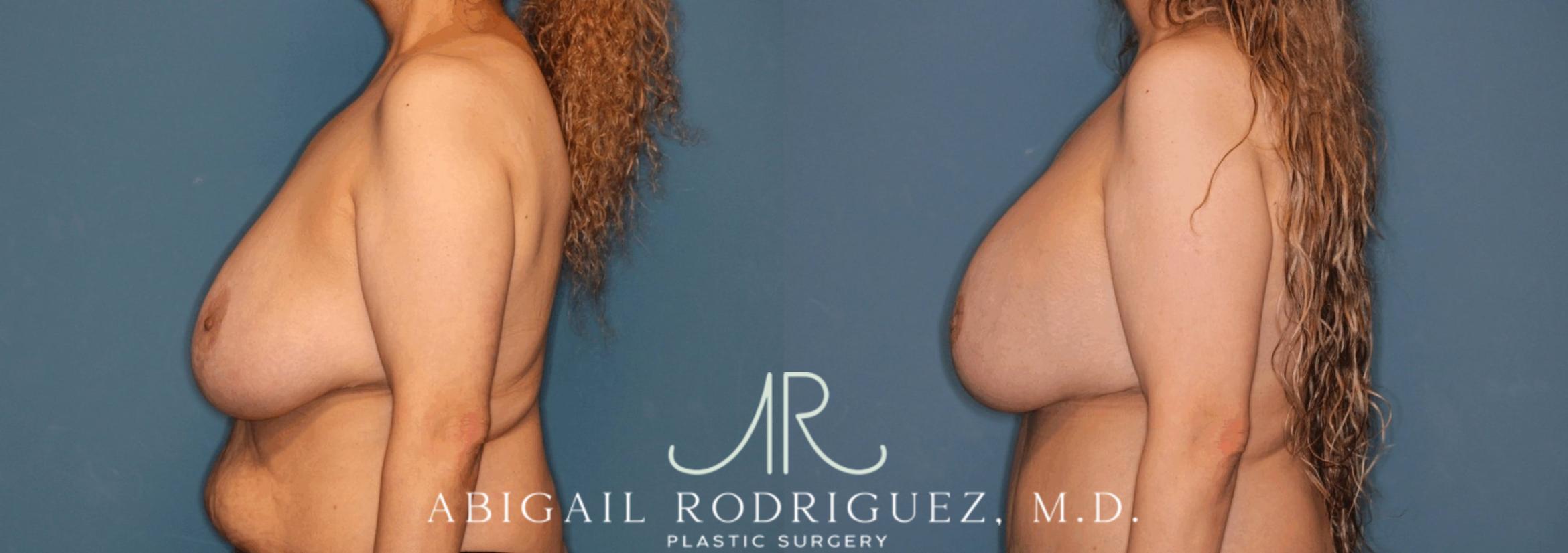 Before & After Breast Lift with Augmentation Case 345997 Left Side View in Houston, TX