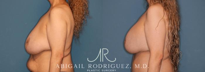 Before & After Breast Lift with Augmentation Case 345997 Left Side View in Houston, TX