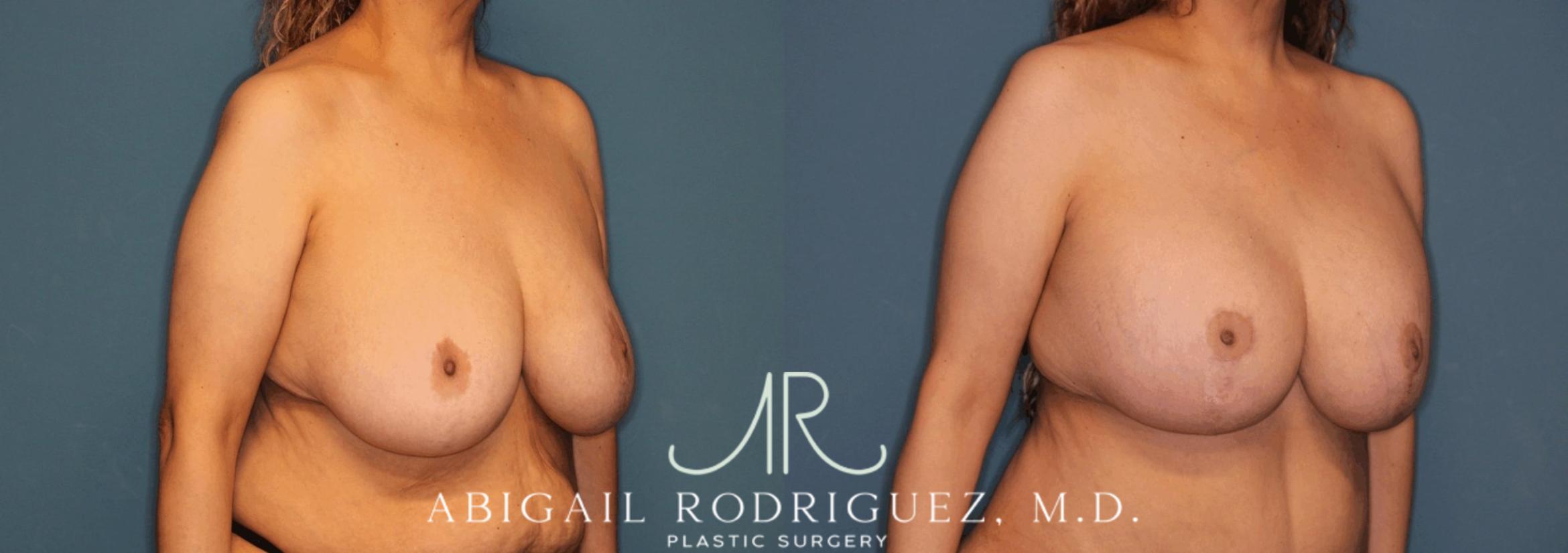 Before & After Breast Lift with Augmentation Case 345997 Right Oblique View in Houston, TX