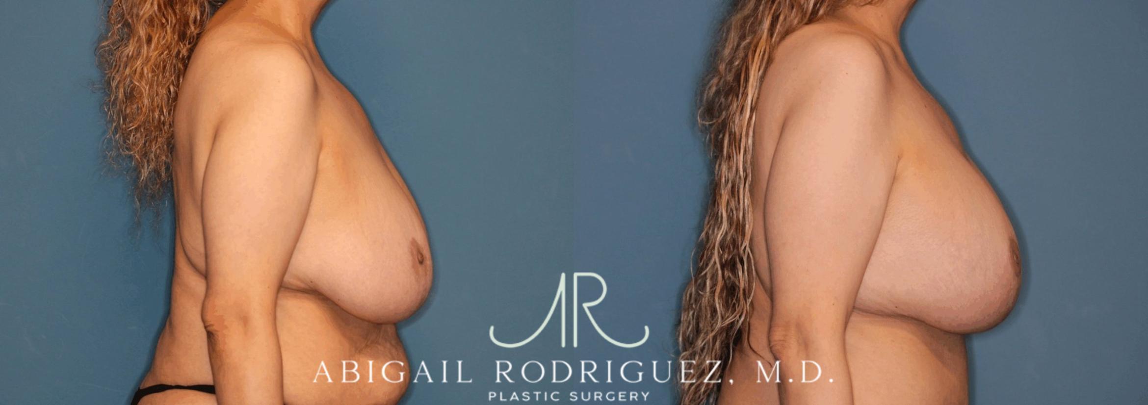 Before & After Breast Lift with Augmentation Case 345997 Right Side View in Houston, TX