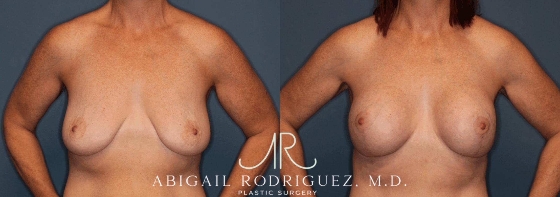 Before & After Breast Lift with Augmentation Case 345998 Front Arms Out View in Houston, TX