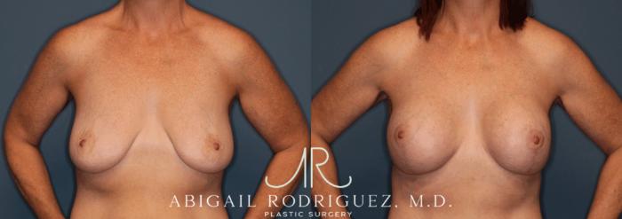 Before & After Breast Lift with Augmentation Case 345998 Front Arms Out View in Houston, TX