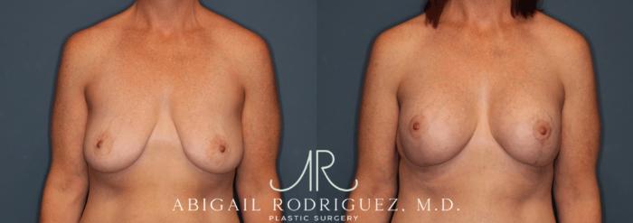 Before & After Breast Lift with Augmentation Case 345998 Front View in Houston, TX