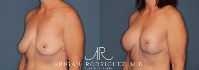 Before & After Breast Lift with Augmentation Case 345998 Left Oblique View in Houston, TX