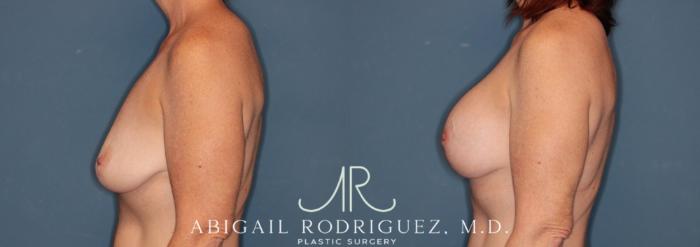 Before & After Breast Lift with Augmentation Case 345998 Left Side View in Houston, TX