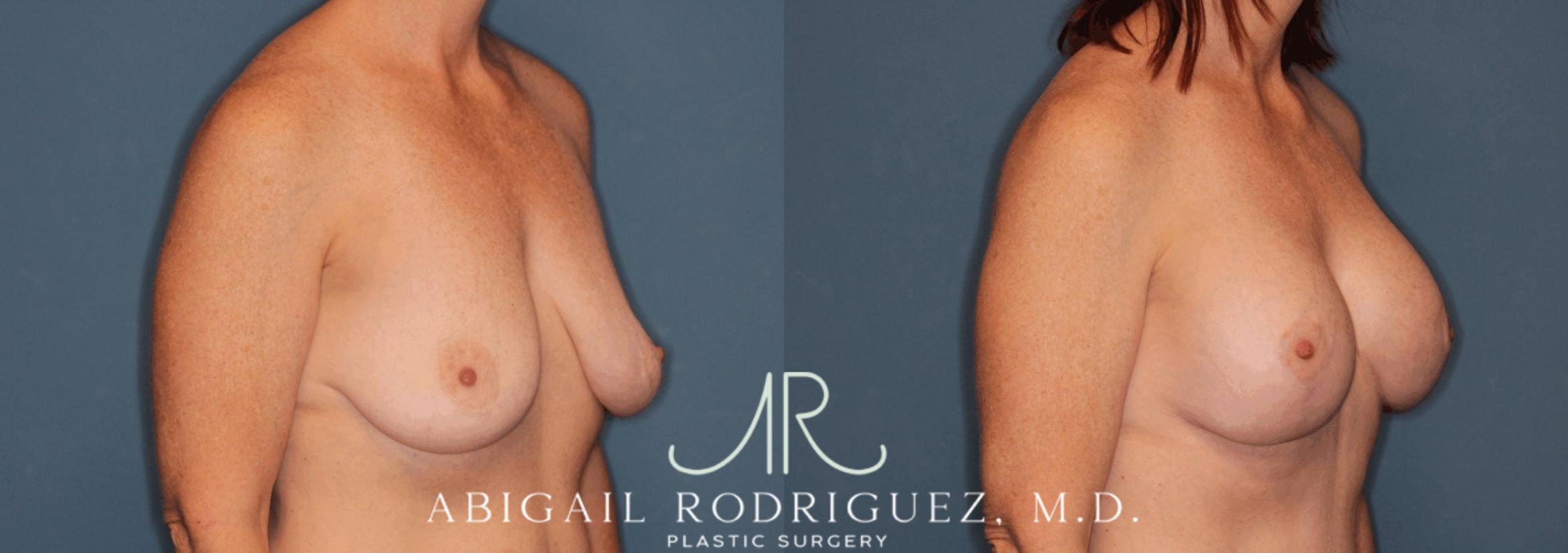Before & After Breast Lift with Augmentation Case 345998 Right Oblique View in Houston, TX