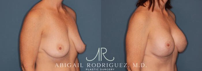 Before & After Breast Lift with Augmentation Case 345998 Right Oblique View in Houston, TX