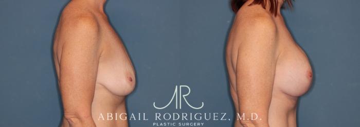 Before & After Breast Lift with Augmentation Case 345998 Right Side View in Houston, TX