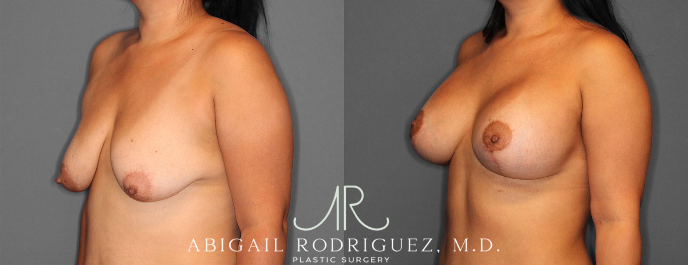 Before & After Breast Lift with Augmentation Case 254145 View 2 View in Houston, TX