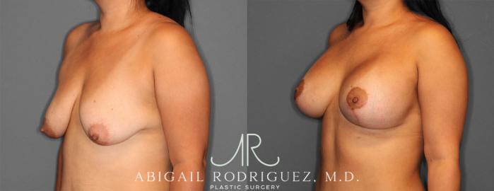 Before & After Breast Lift with Augmentation Case 254145 View 2 View in Houston, TX