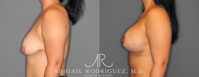 Before & After Breast Lift with Augmentation Case 254145 View 3 View in Houston, TX