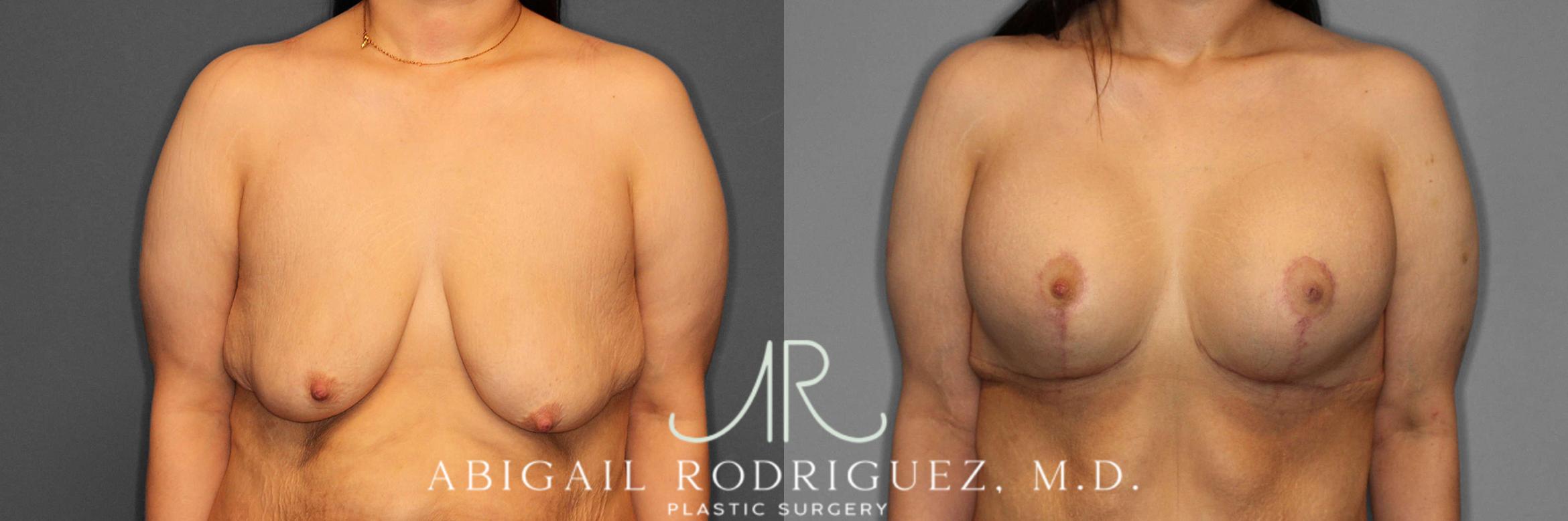 Before & After Breast Lift with Augmentation Case 254861 View 1 View in Houston, TX
