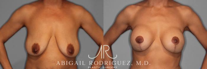 Before & After Breast Lift with Augmentation Case 345996 Front Arms Out View in Houston, TX