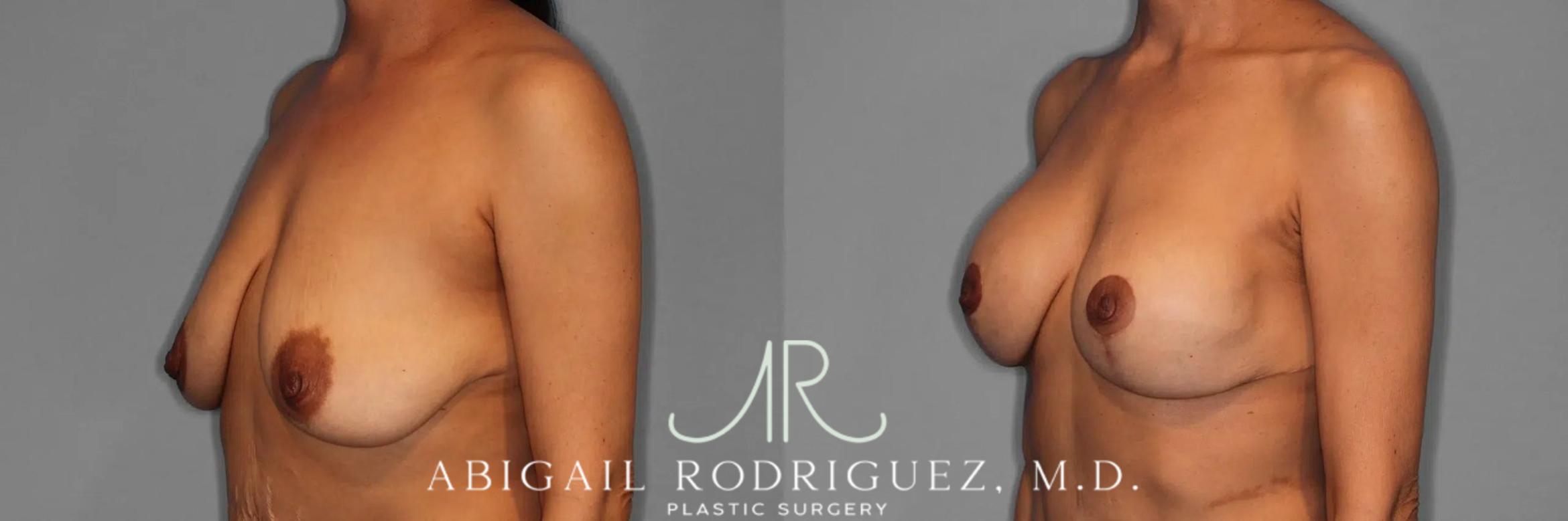 Before & After Breast Lift with Augmentation Case 345996 Left Oblique View in Houston, TX