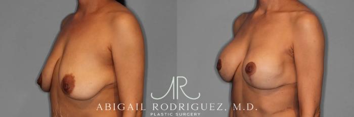 Before & After Breast Lift with Augmentation Case 345996 Left Oblique View in Houston, TX