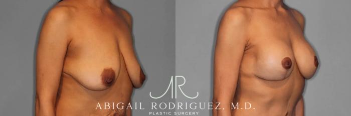 Before & After Breast Lift with Augmentation Case 345996 Right Oblique View in Houston, TX