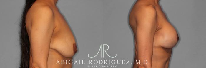 Before & After Breast Lift with Augmentation Case 345996 Right Side View in Houston, TX