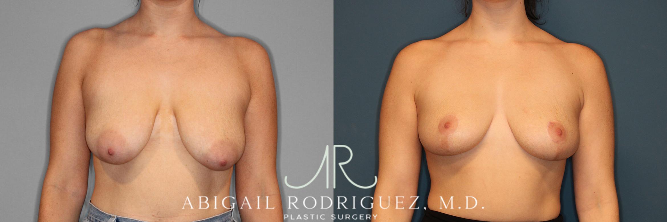 Before & After Breast Reduction Case 254021 View 1 View in Houston, TX