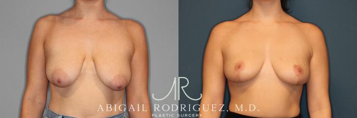 Before & After Breast Reduction Case 254021 View 1 View in Houston, TX