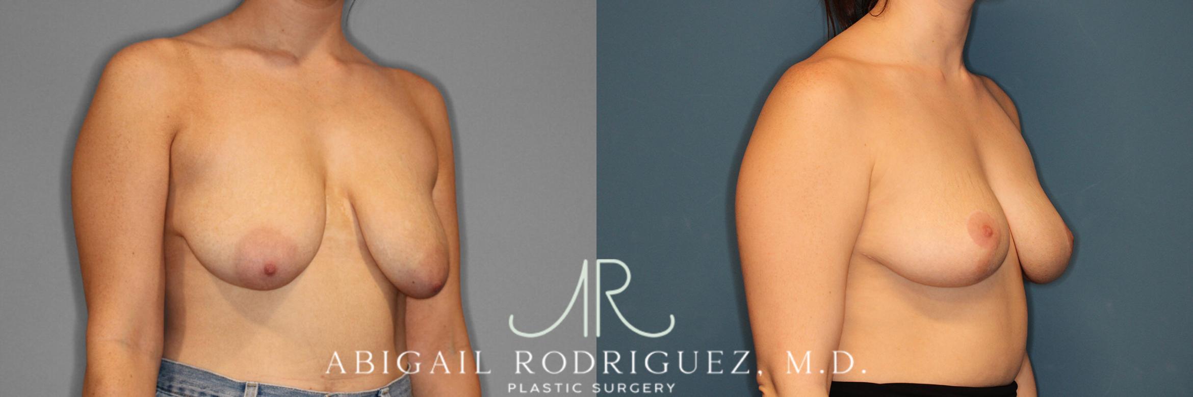 Before & After Breast Reduction Case 254021 View 2 View in Houston, TX