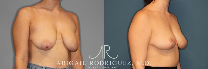 Before & After Breast Reduction Case 254021 View 2 View in Houston, TX