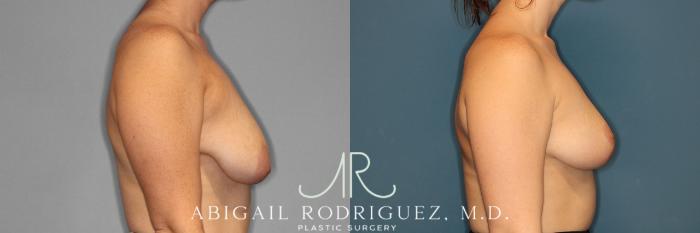 Before & After Breast Reduction Case 254021 View 3 View in Houston, TX