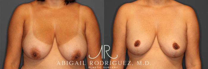 Before & After Breast Reduction Case 258012 View 1 View in Houston, TX