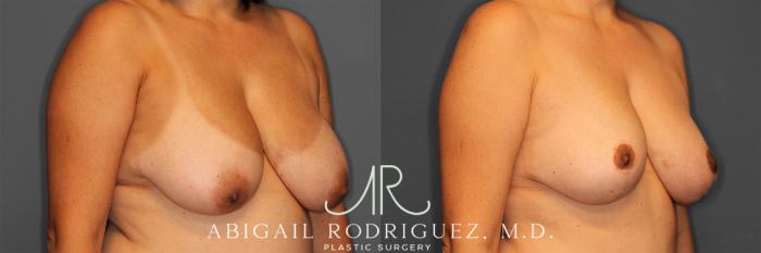 Before & After Breast Reduction Case 258012 View 2 View in Houston, TX
