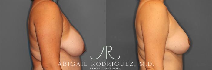 Before & After Breast Reduction Case 258012 View 3 View in Houston, TX