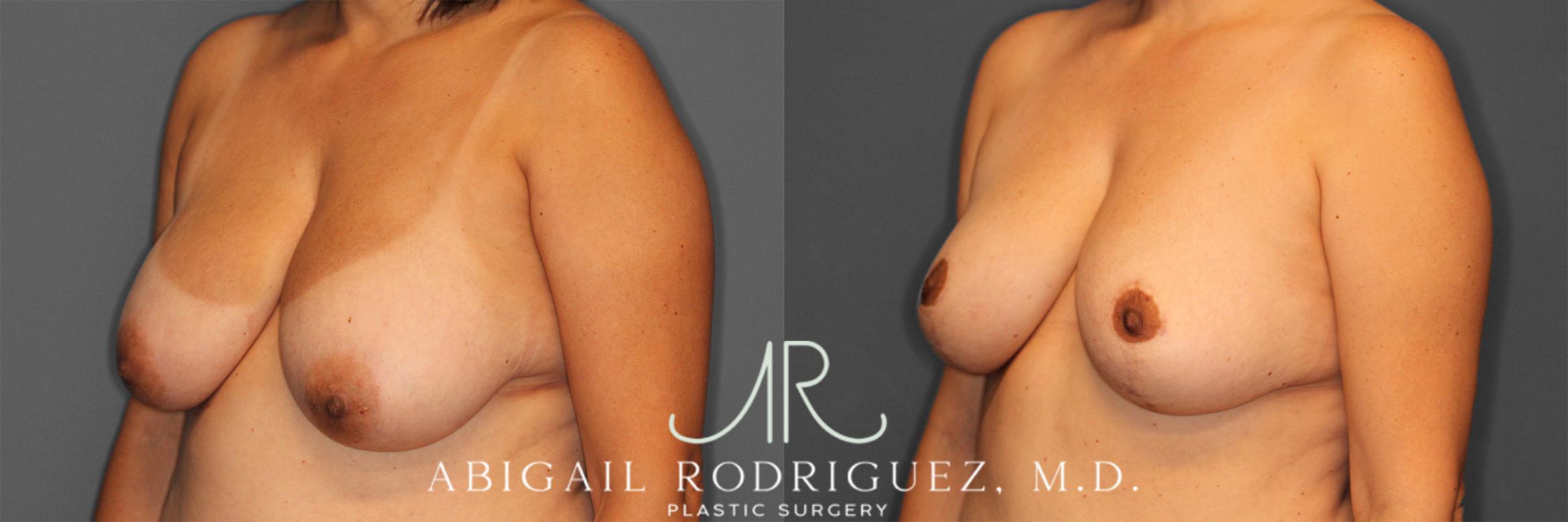 Before & After Breast Reduction Case 258012 View 4 View in Houston, TX