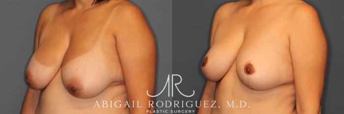 Before & After Breast Reduction Case 258012 View 4 View in Houston, TX