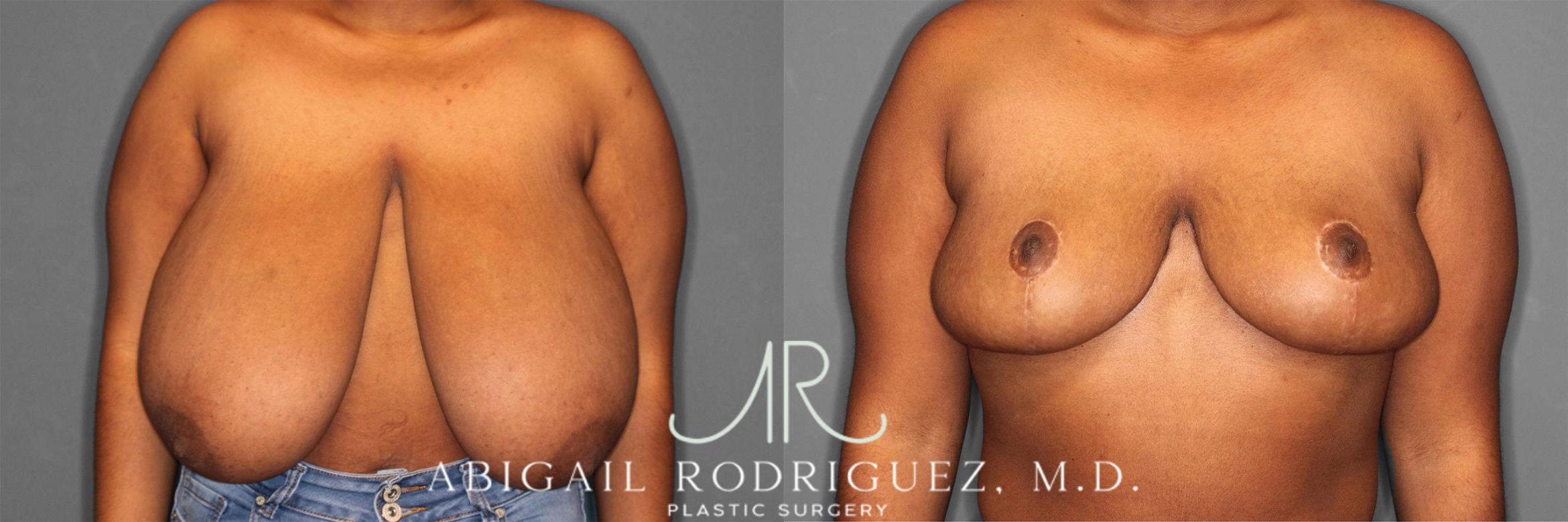 Before & After Breast Reduction Case 258301 View 1 View in Houston, TX