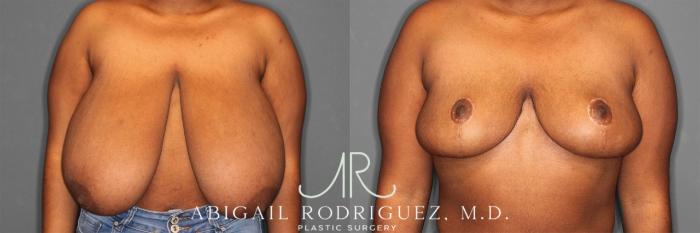 Before & After Breast Reduction Case 258301 View 1 View in Houston, TX