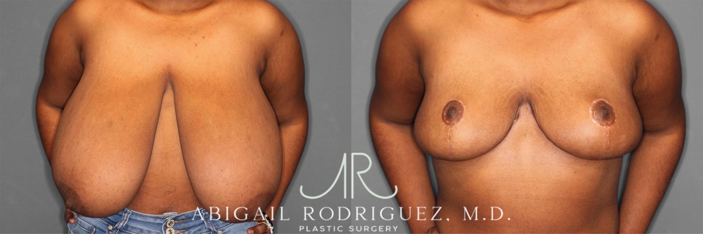 Before & After Breast Reduction Case 258301 View 2 View in Houston, TX