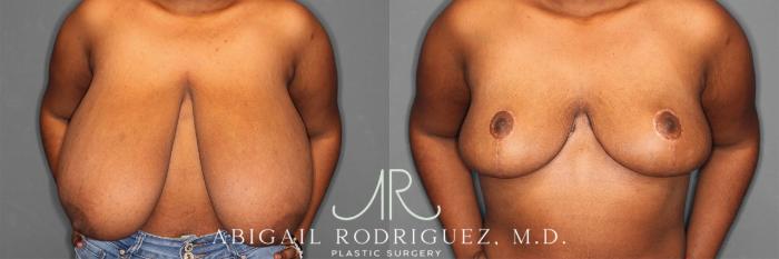 Before & After Breast Reduction Case 258301 View 2 View in Houston, TX