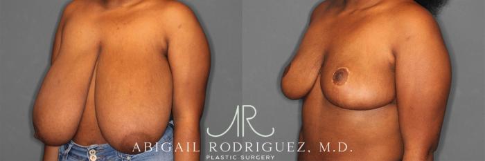 Before & After Breast Reduction Case 258301 View 3 View in Houston, TX