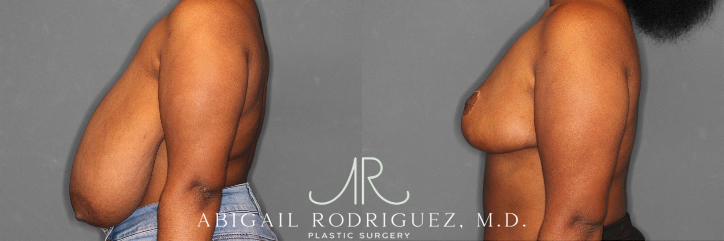 Before & After Breast Reduction Case 258301 View 4 View in Houston, TX