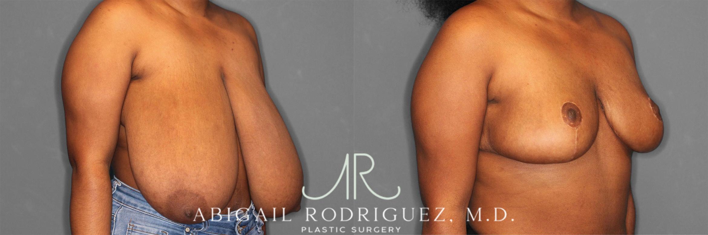 Before & After Breast Reduction Case 258301 View 5 View in Houston, TX